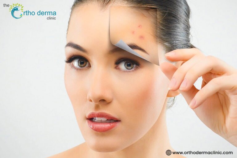 Different Types of Pimples and How to Tackle Them