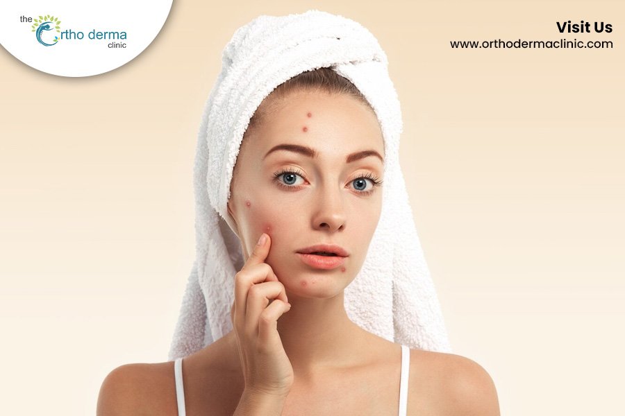 Acne Scars Treatment in Ludhiana | Orthoderma Clinic