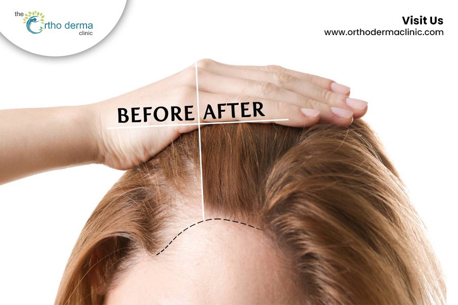 GFC Therapy for hair growth | Best Dermatologist in Ludhiana