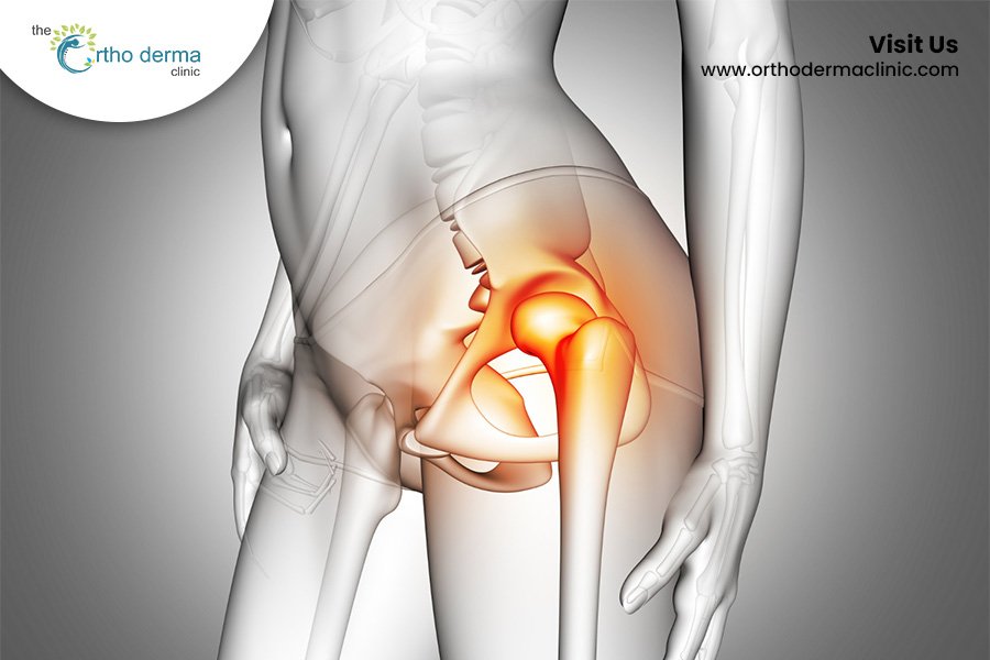 Hip Replacement Surgery in Ludhiana | Orthoderma Clinic