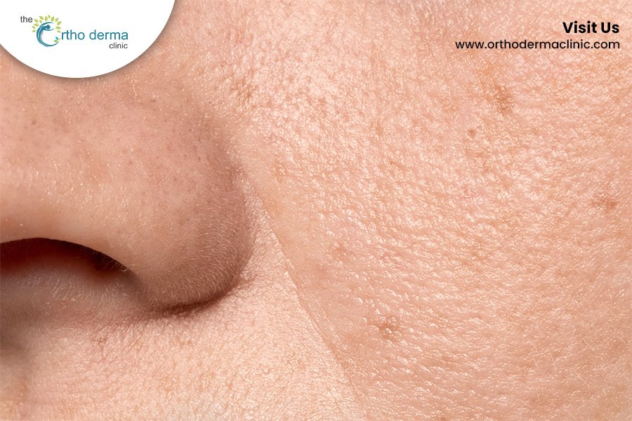 Causes and Treatments of Open Pores