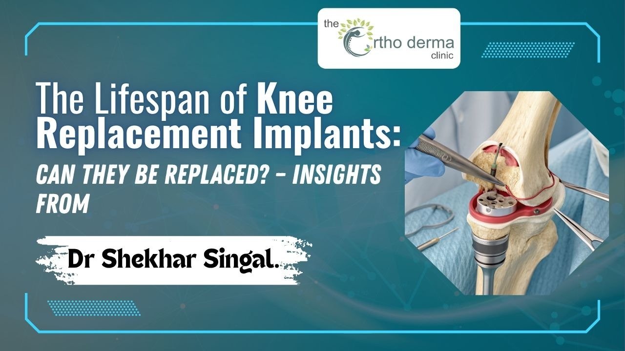 Knee Replacement Implants