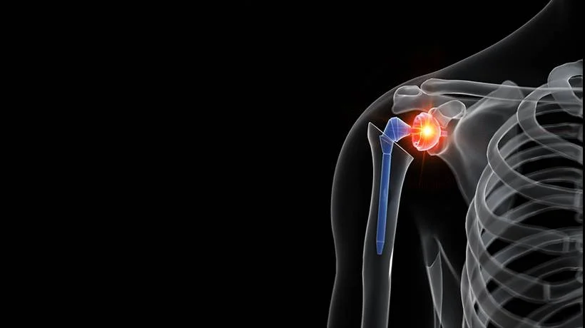 Shoulder Replacement Surgery in Ludhiana | Orthoderma Clinic