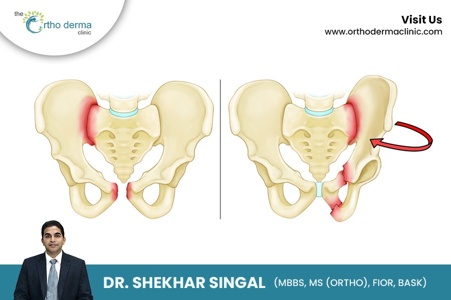 Understanding Pelvic Fractures | Orthoderma Clinic