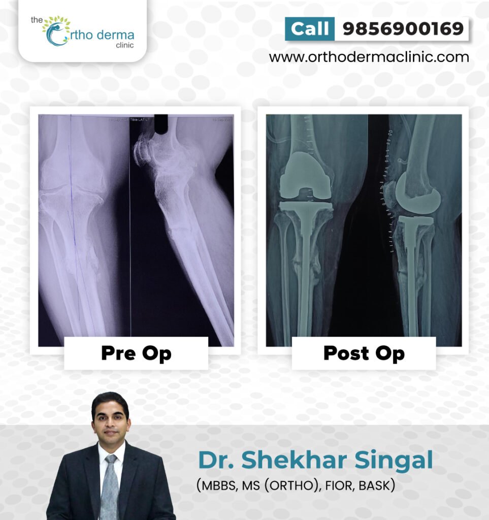 Before and after of knee replacement surgery | Orthoderma Clinic