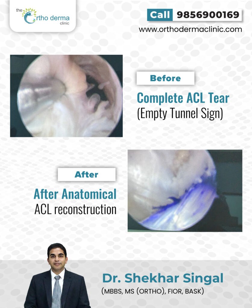 ACL Reconstruction | Orthoderma Clinic Ludhiana