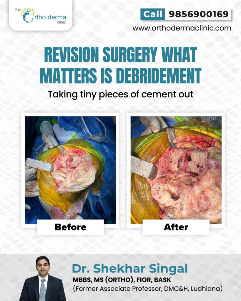 Knee Replacement Surgery | Orthoderma Clinic Ludhiana