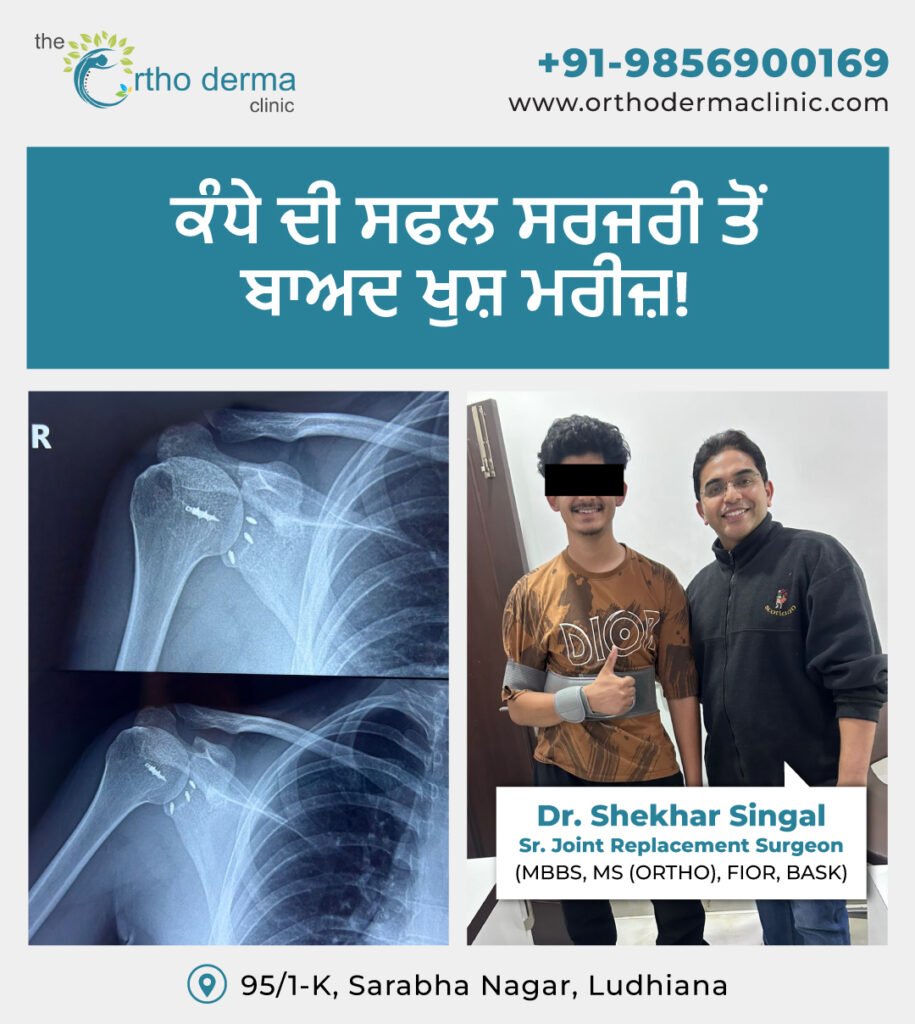 Shoulder Replacement Surgery | Orthoderma Clinic