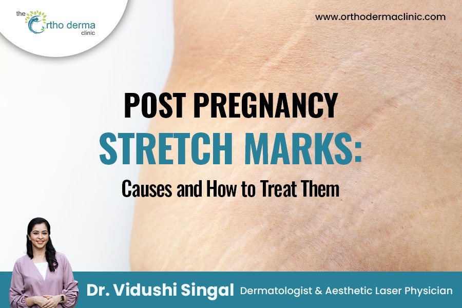 Stretch Marks After Birth? Here’s What Works