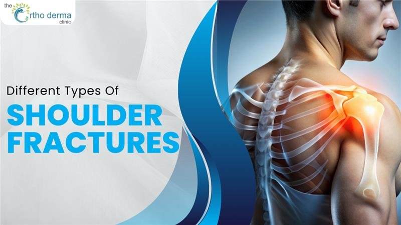 Types Of Shoulder Fractures