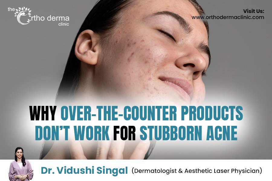 Why OTC Acne Products Don’t Work for Stubborn Acne | Dermatologist Insight