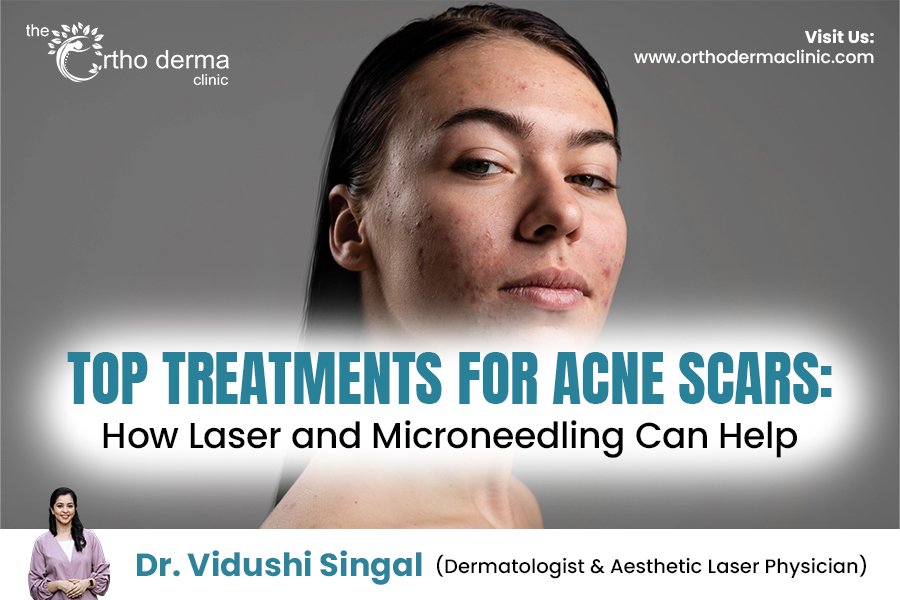 Top Treatments for Acne Scars: How Laser and Microneedling Can Help