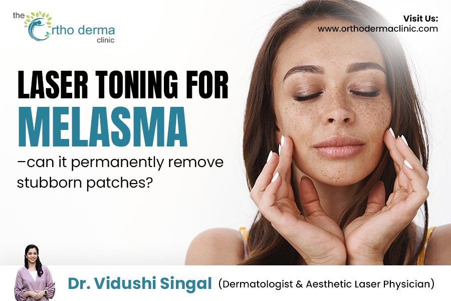 Laser Toning for Melasma